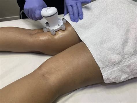 Cellulite Treatment Edmonton .